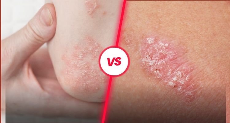 What is the Difference Between Eczema and Psoriasis?